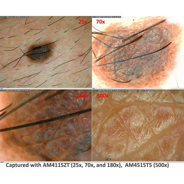 Dino-Lite DermaScope 5Mpx, 10-70 & 200x 